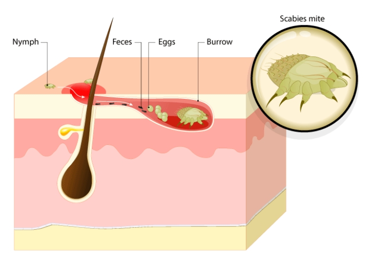 Cross-section of a scabies mite burrow