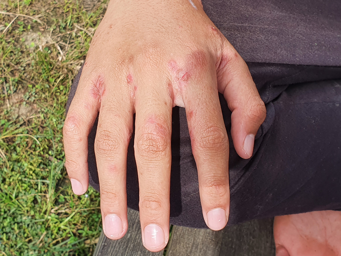 Close up of hand with with ulcer filled with pus condition caused of scabies infection